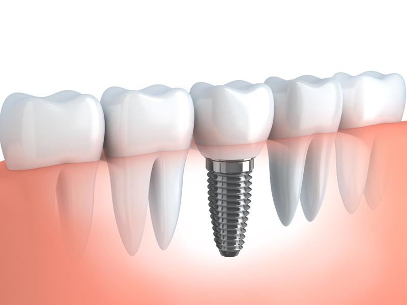 Dental Implants  Duluth, MN
